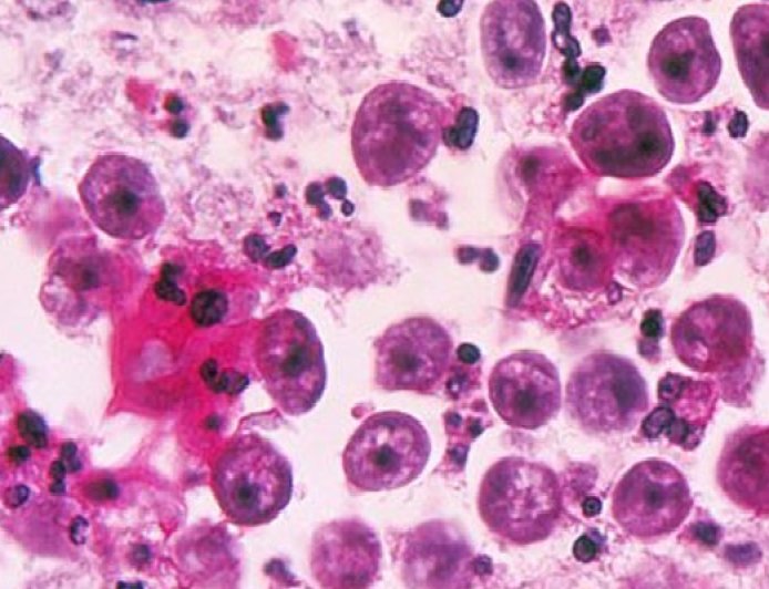 NIH issues advisory on Naegleria